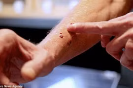 Vết cắn có 1 lỗ là rắn độc