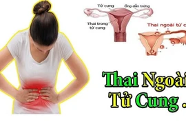 Cách phòng ngừa thai ngoài tử cung