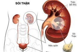 Sỏi niệu quản 1/3 trên có tán được không?