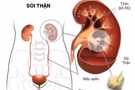 Sỏi niệu quản 1/3 trên có tán được không?
