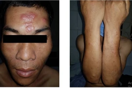 Tổn thương da dai dẳng do bệnh phong