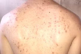 Lý giải tại sao mụn lưng nhiều và cách phòng tránh 