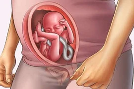 Tai biến sản khoa sa dây rốn