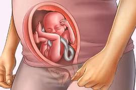 Tai biến sản khoa sa dây rốn