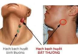 Hạch to không đau cẩn thận u lympho ác tính không Hodgkin
