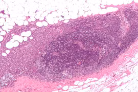 Hạt nano gây mê tấn công tế bào thần kinh để ức chế khối u