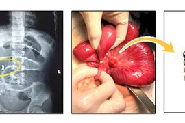 Bé gái 4 tuổi thủng ruột vì nuốt bi nam châm trong đồ chơi