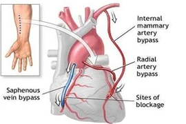 Mổ bắc cầu nối động mạch vành