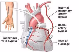Mổ bắc cầu nối động mạch vành