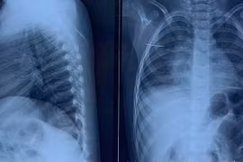 Nội soi lấy kim khâu trong ngực trẻ 3 tuổi