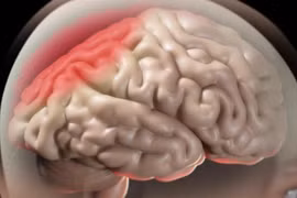 Phù não khi điều trị ung thư