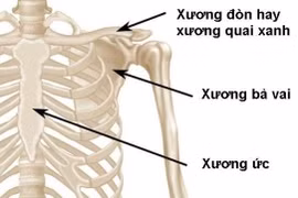 Gãy xương đòn lâu liền