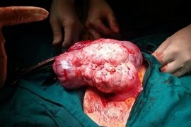 Cắt u quái buồng trứng ở cụ già hơn 90 tuổi