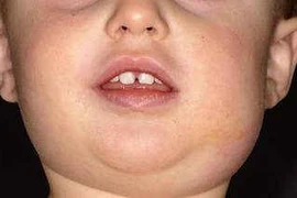 Các bài thuốc trị quai bị