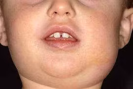 Các bài thuốc trị quai bị