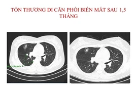 Hết u phổi và u não di căn sau 1,5 tháng điều trị
