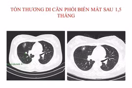Hết u phổi và u não di căn sau 1,5 tháng điều trị