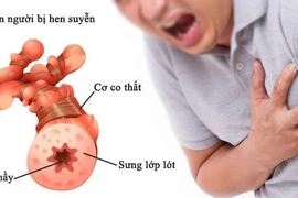 Các dấu hiệu nặng của hen phế quản