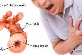 Các dấu hiệu nặng của hen phế quản