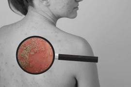 Cải thiện bệnh vảy nến mủ an toàn, hiệu quả nhờ sản phẩm thảo dược