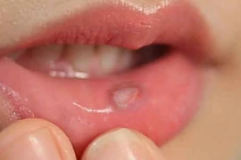 Miệng khô, có vết loét