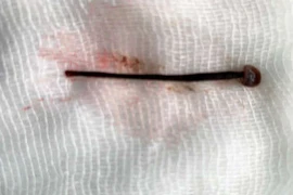 Người phụ nữ bị đỉa chui vào mũi sau khi rửa mặt ở khe suối