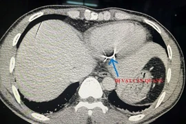 Đi cắt cỏ bị dây thép gai đâm vào tim