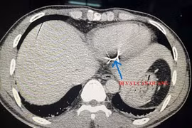 Đi cắt cỏ bị dây thép gai đâm vào tim
