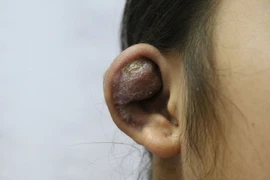 Tai biến dạng do bấm khuyên làm đẹp