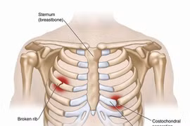 Đau vệ xương sườn
