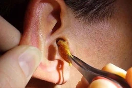 Khi nào nên lấy ráy tai?