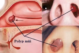 Polyp mũi lành tính và ác tính