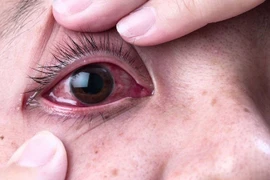 Hỏng mắt vì tự lấy dị vật