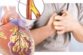 Đau ngực khác nhau nhưng đều kết luận bệnh mạch vành