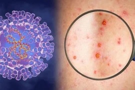 Nghi ngờ virus đậu mùa khỉ lây qua đường tình dục 