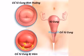 Quan hệ thô bạo dễ viêm cổ tử cung