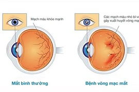 Biến chứng tiểu đường