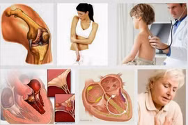  Xác định đau khớp gối do thấp tim