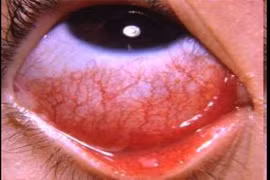 Viêm nhiễm bề mặt nhãn cầu do virus nhóm adeno 