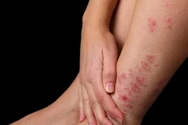 Điều trị vảy nến ở chân như thế nào cho hiệu quả?