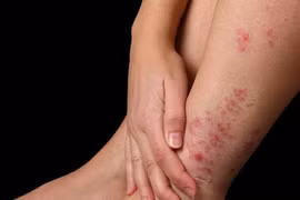 Điều trị vảy nến ở chân như thế nào cho hiệu quả?