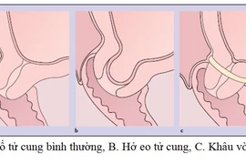 Khâu vòng tử cung cứu thai nhi 18 tuần tuổi