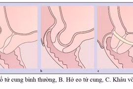 Khâu vòng tử cung cứu thai nhi 18 tuần tuổi
