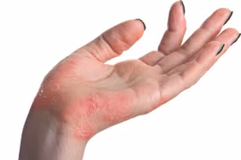 4 điều bạn nhất định phải biết về bệnh vẩy nến!