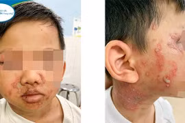 Viêm da tiếp xúc do kiến ba khoang lại chữa zona thần kinh