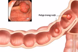 Cảnh giác với polyp đại trực tràng ở trẻ nhỏ