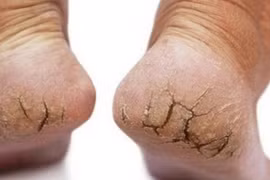 Cắt nứt nẻ khiến chân hoại tử