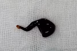 Con đỉa được gắp ra khỏi mũi bệnh nhân