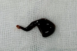 Con đỉa được gắp ra khỏi mũi bệnh nhân