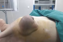 U vú đặc biệt phát triển nhanh vì chữa thuốc Nam